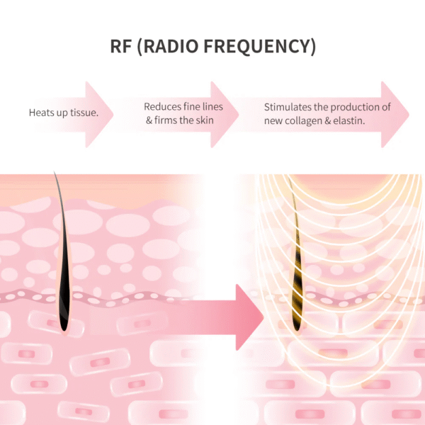 纖體去紋按摩儀 rf body massager