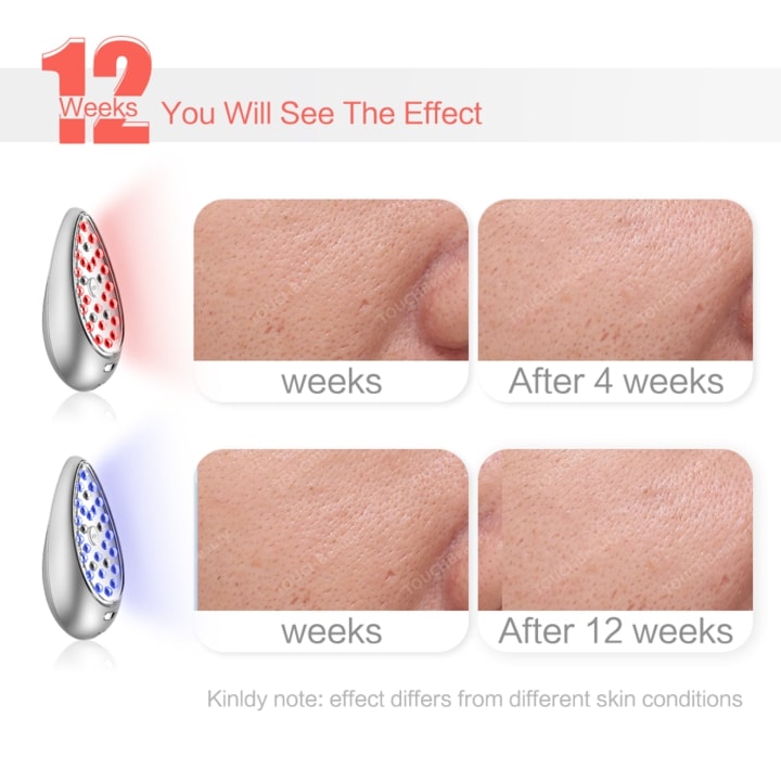 淨痘抗皺光療儀 light therapy device (red & blue)