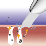 glow超聲淨膚儀 ultrasonic scrub device